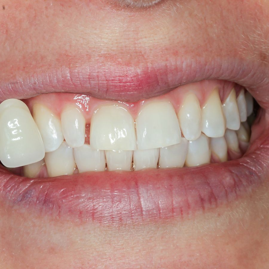 teeth-whitening-after-smile-5-3dental